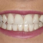 Composite Bonding: A Minimally Invasive Approach to Smile Makeovers in London