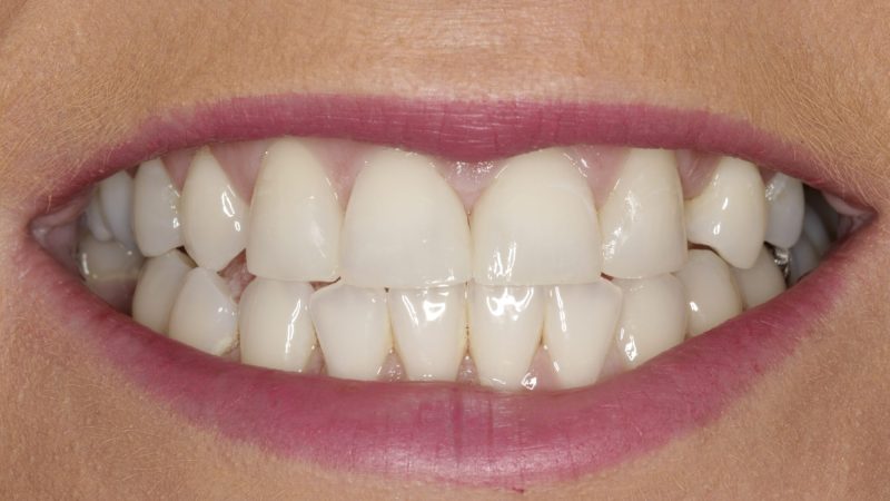 Composite Bonding: A Minimally Invasive Approach to Smile Makeovers in London