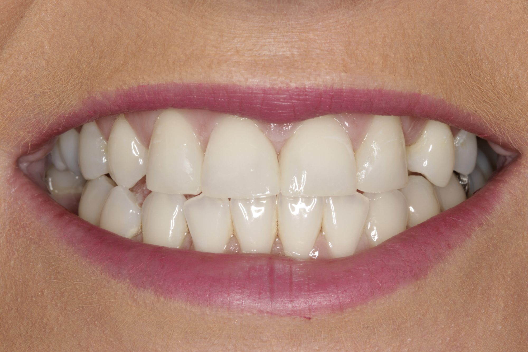 Composite Bonding: A Minimally Invasive Approach to Smile Makeovers in London